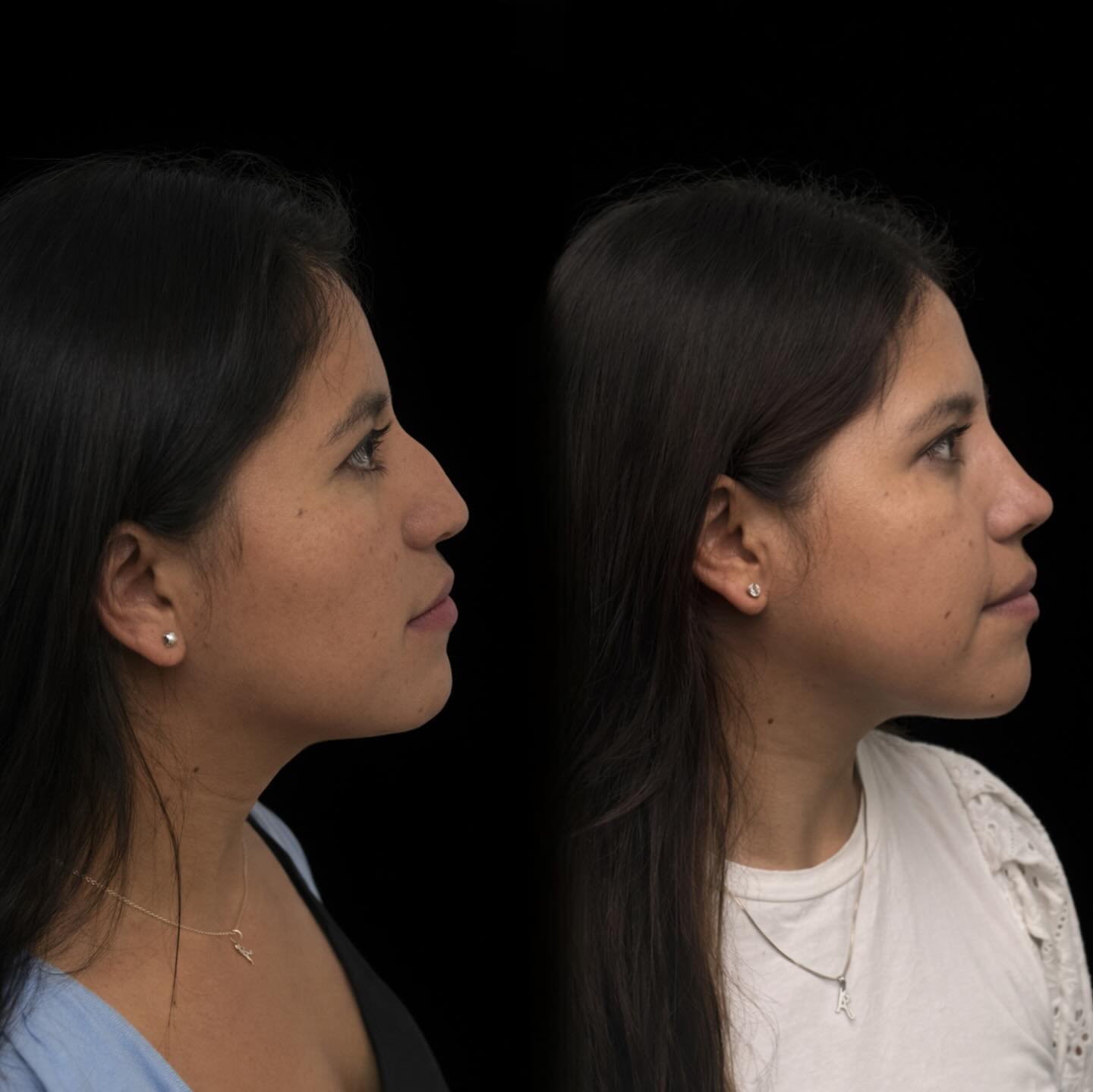 Antes y después de la rinoplastía, perfil
